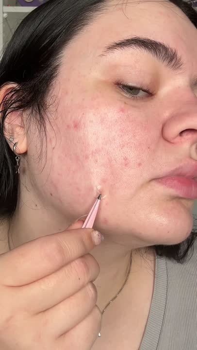 Story Cover - New Garnier 8 Hour Spot Patch